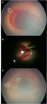 Analysis of non-retinopathy of prematurity (ROP)–related fundus hemorrhage in preterm infants in China